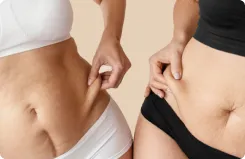Liposuction - Goals Plastic Surgery®